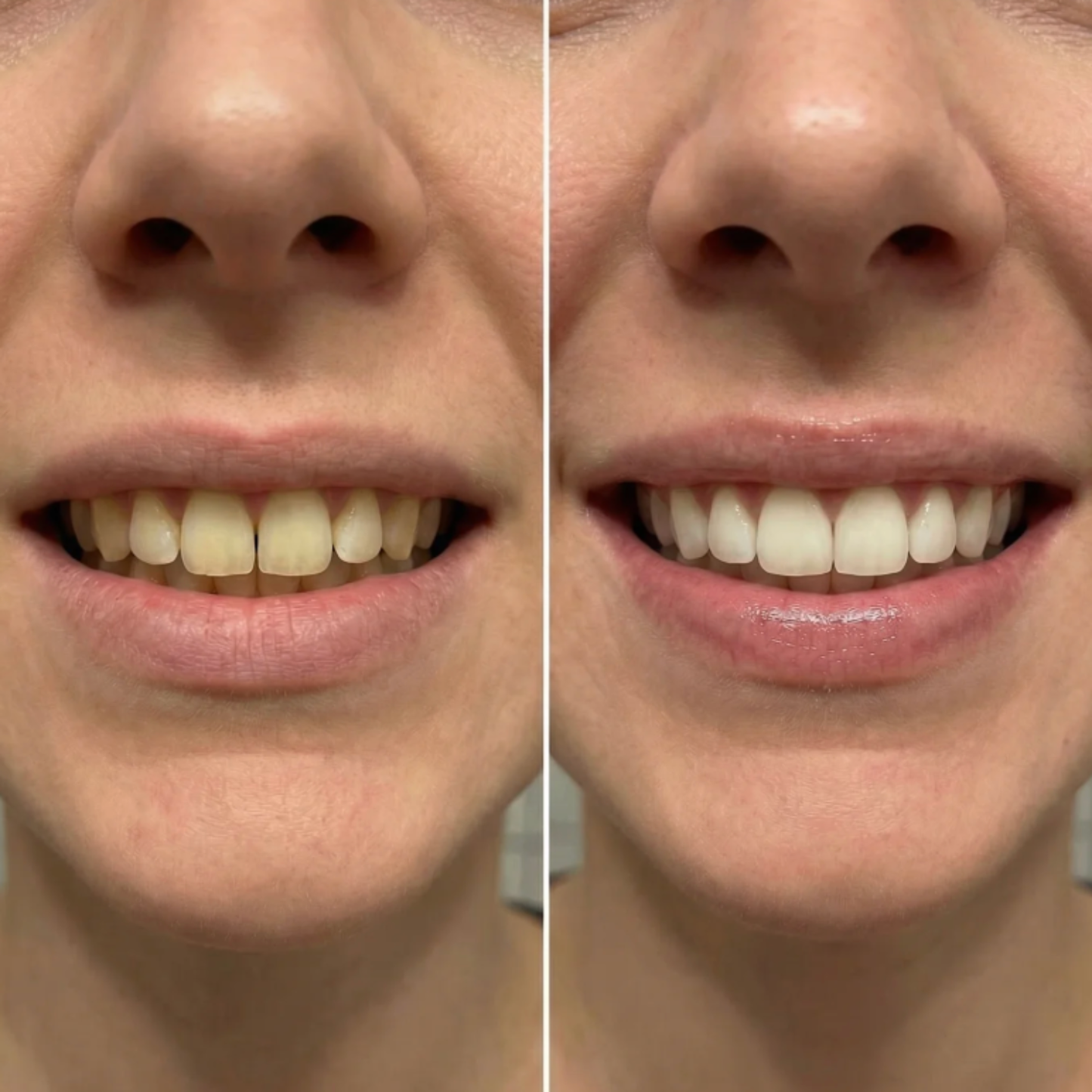 Calvera Whitening Strips