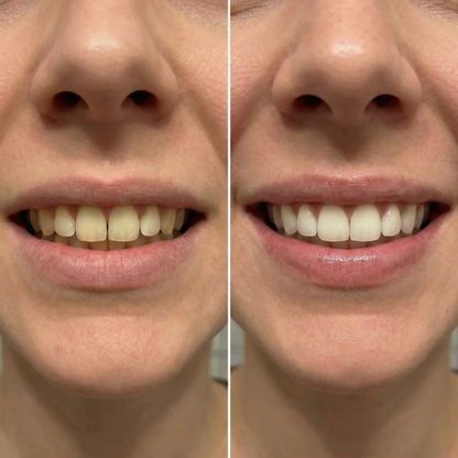 Calvera Whitening Strips