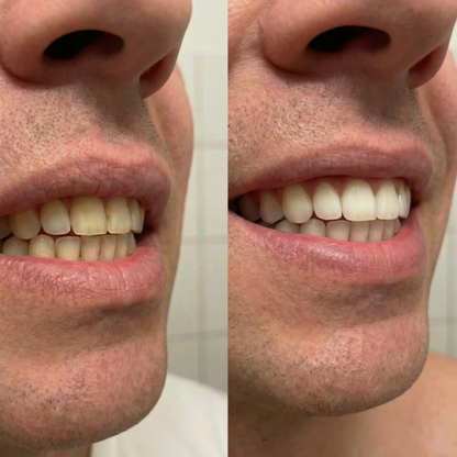 Calvera Whitening Strips